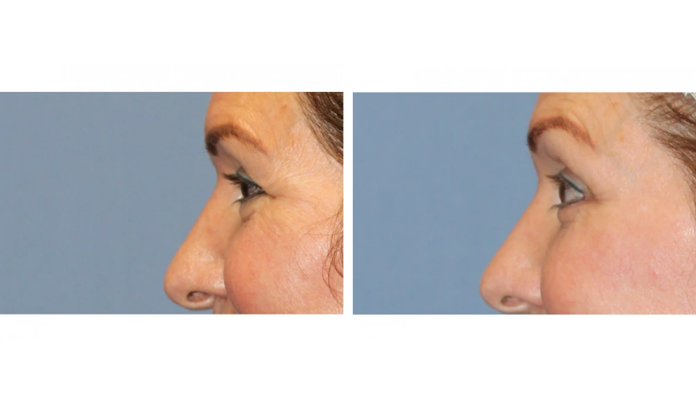 Eyelid Surgery (Blepharoplasty) - Case 8 (4)