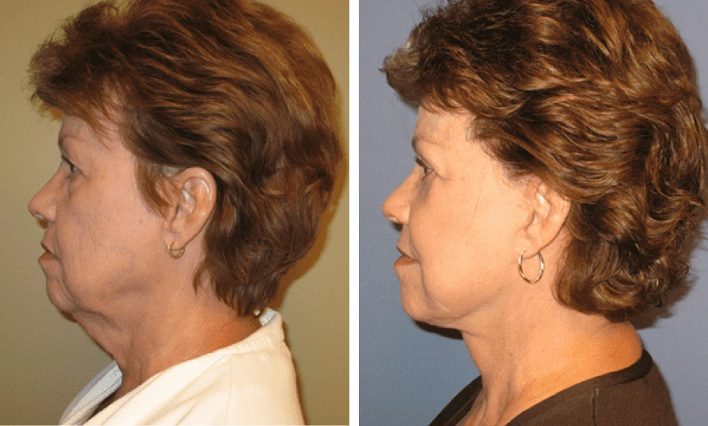 Face Lift - Case 1 (4)