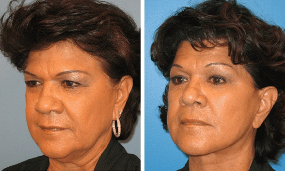Face Lift - Case 2 (3)