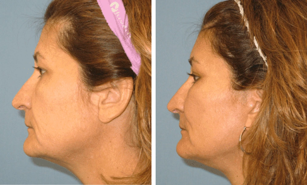 Face Lift - Case 4 (3)