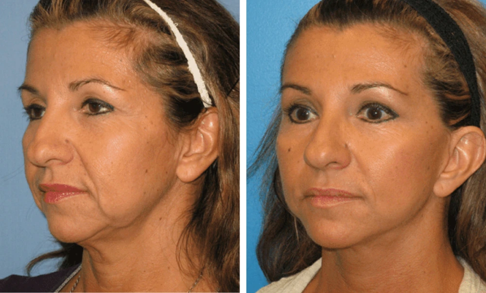 Face Lift - Case 5 (3)