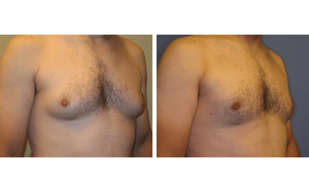 Gynecomastia - Case 1 (1)