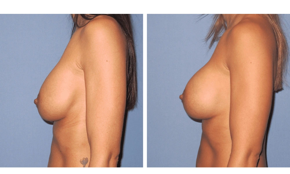 Implant Exchange - Case 4 (4)