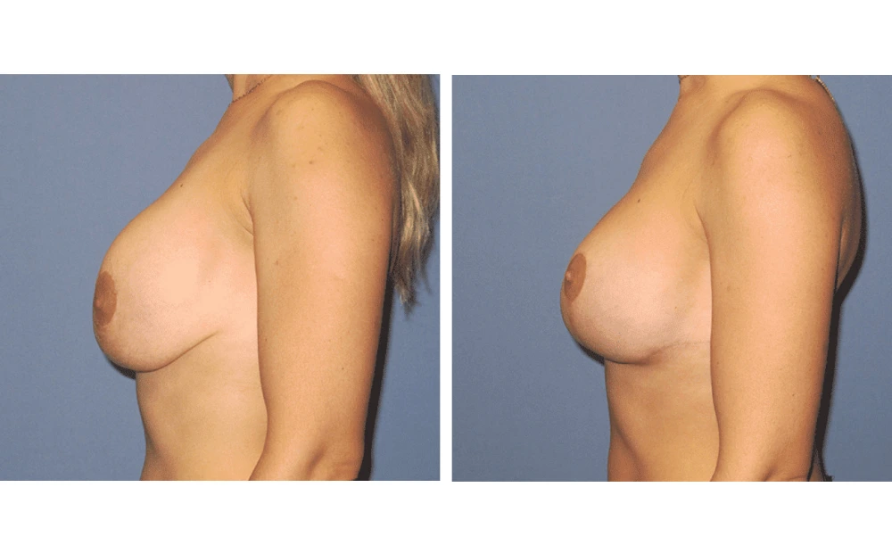 Implant Exchange - Case 8 (4)