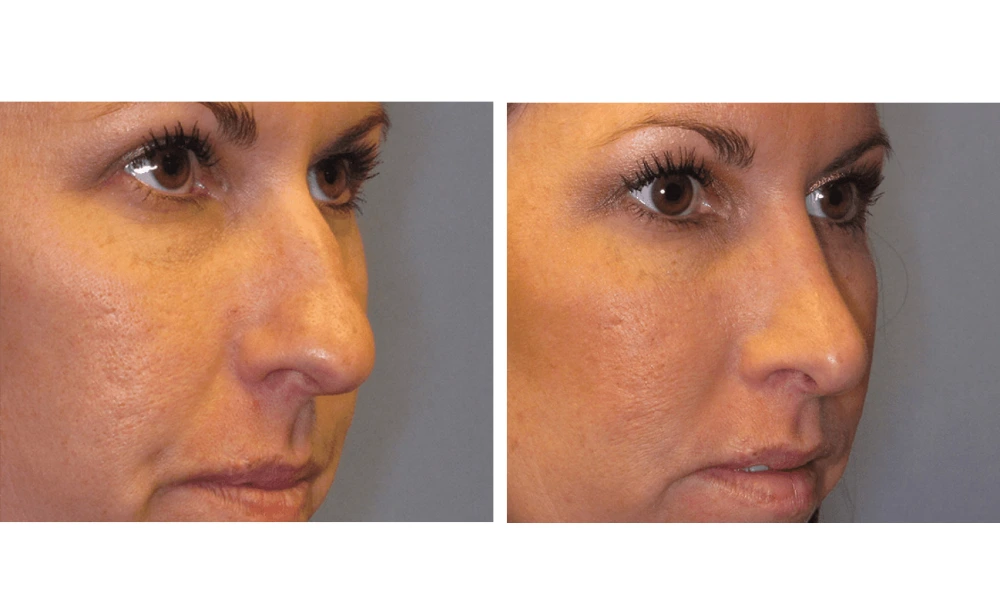 Rhinoplasty - Case 1 (2)