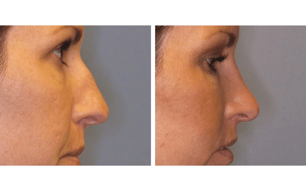 Rhinoplasty - Case 1 (3)