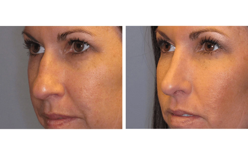 Rhinoplasty - Case 1 (4)