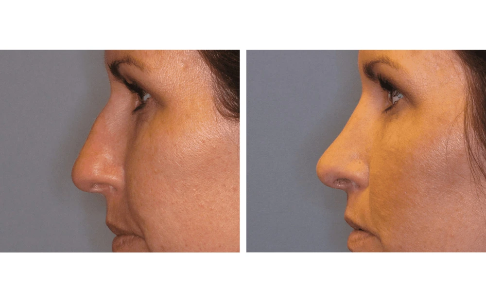 Rhinoplasty - Case 1 (5)