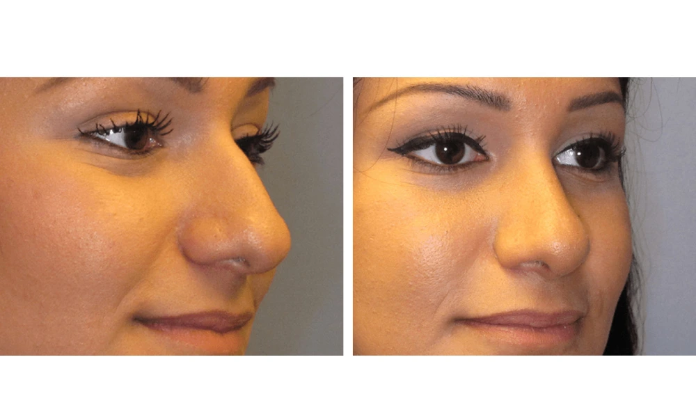 Rhinoplasty - Case 2 (1)