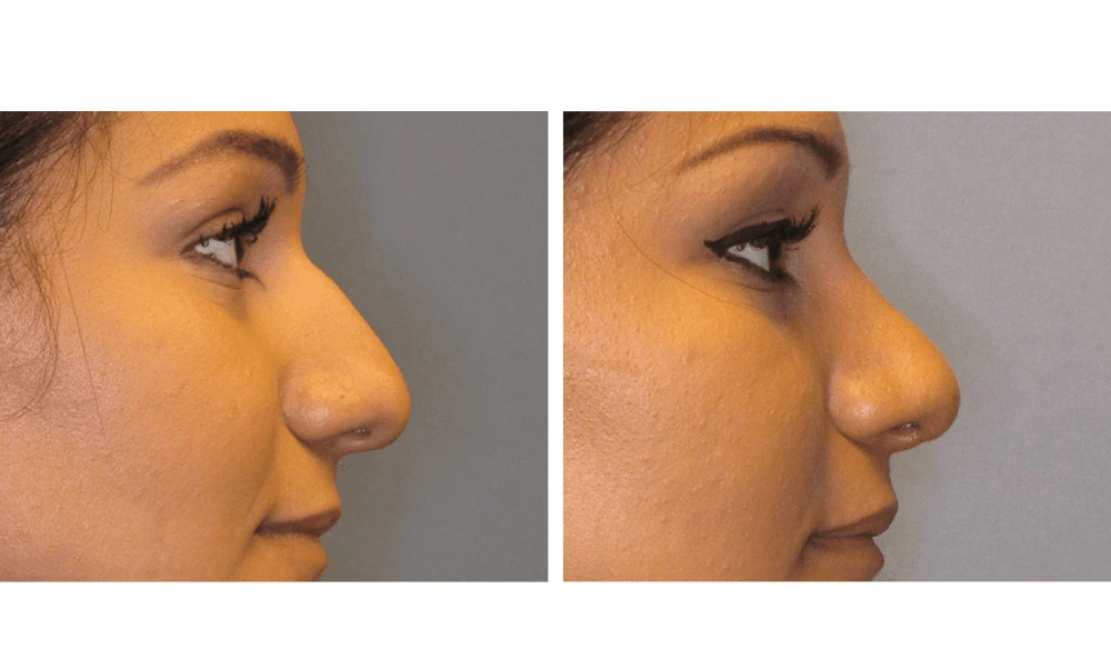 Rhinoplasty - Case 2 (2)
