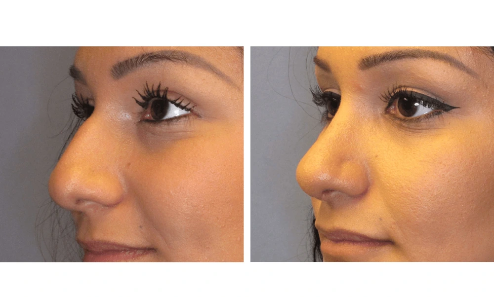 Rhinoplasty - Case 2 (3)