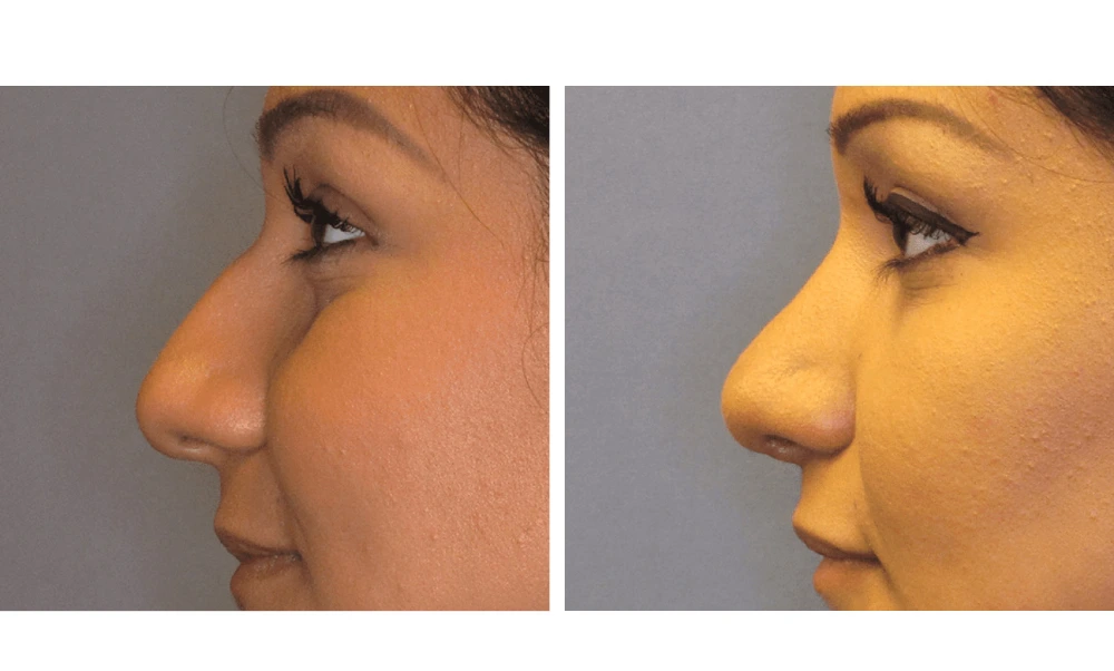Rhinoplasty - Case 2 (4)