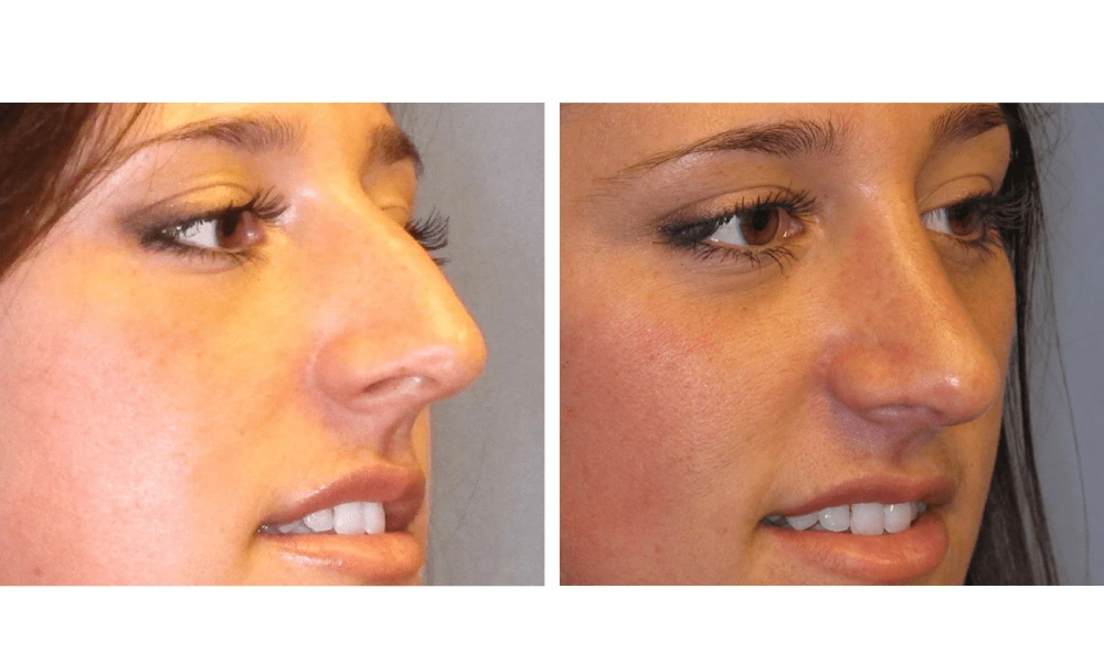 Rhinoplasty - Case 3 (1)