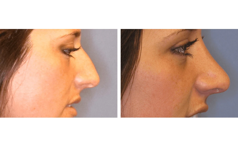 Rhinoplasty - Case 3 (2)