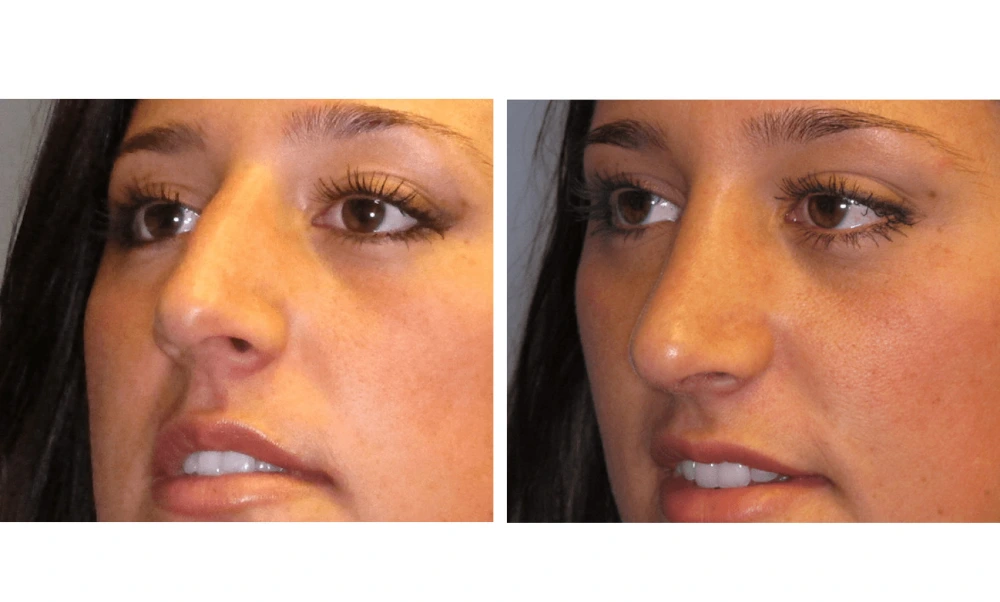 Rhinoplasty - Case 3 (3)