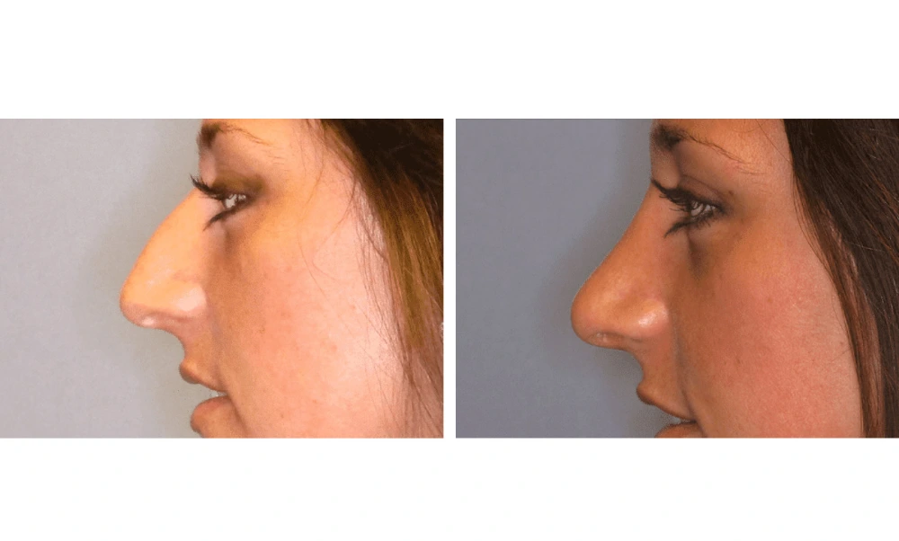 Rhinoplasty - Case 3 (4)
