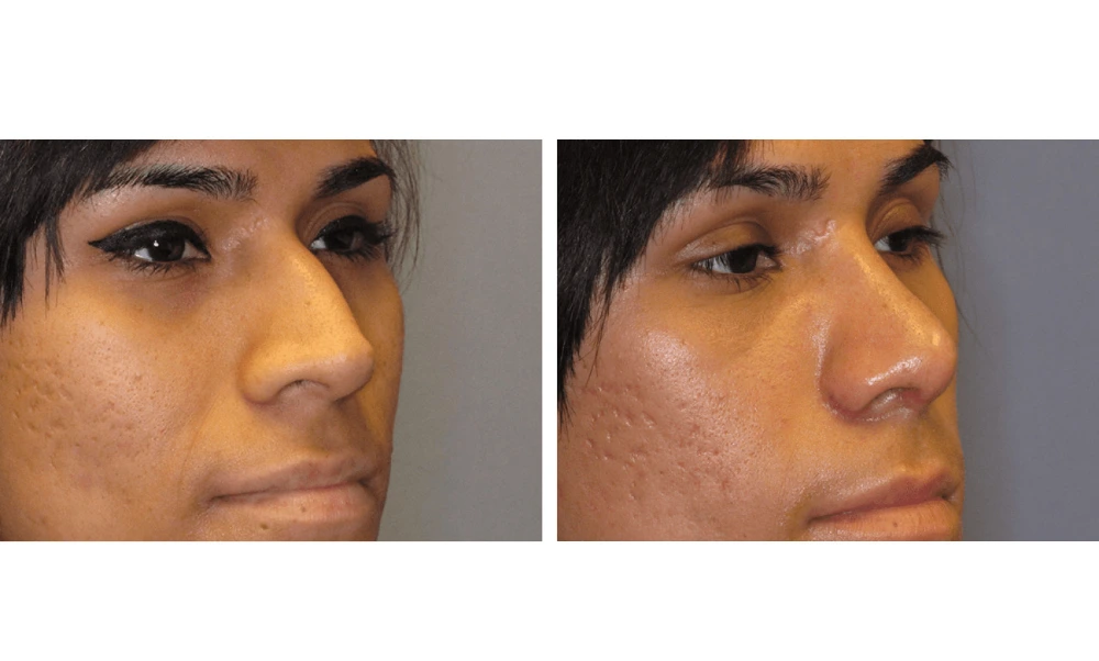 Rhinoplasty - Case 5 (1)