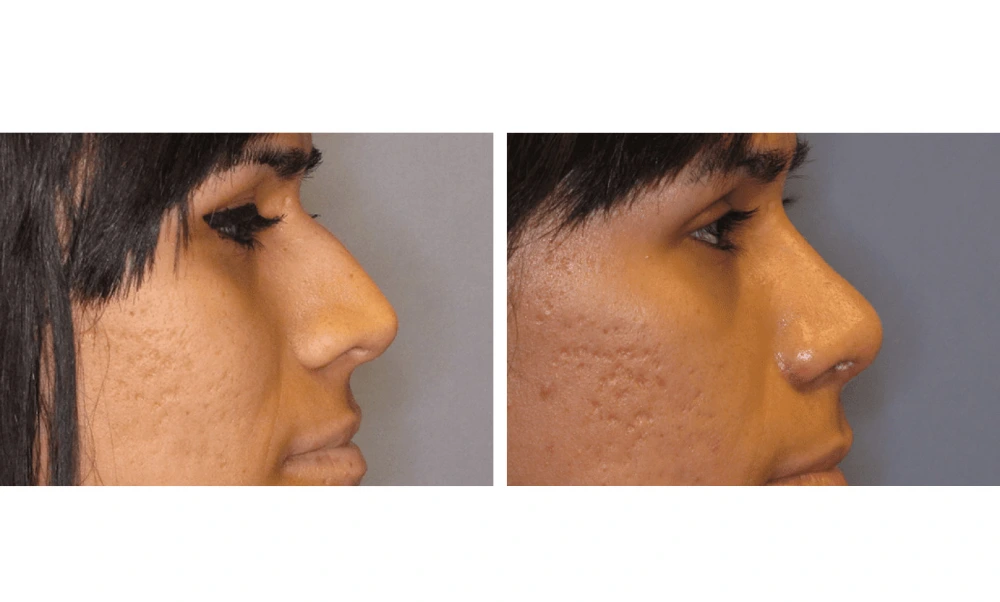 Rhinoplasty - Case 5 (2)