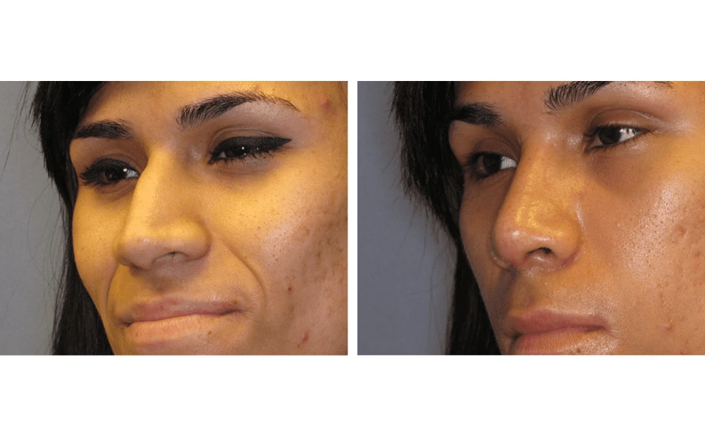 Rhinoplasty - Case 5 (3)