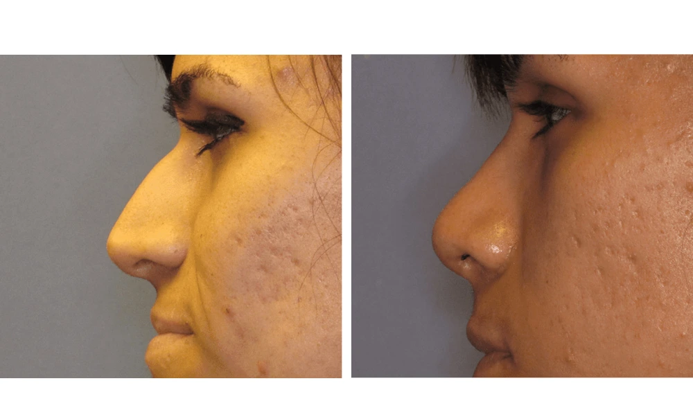 Rhinoplasty - Case 5 (4)