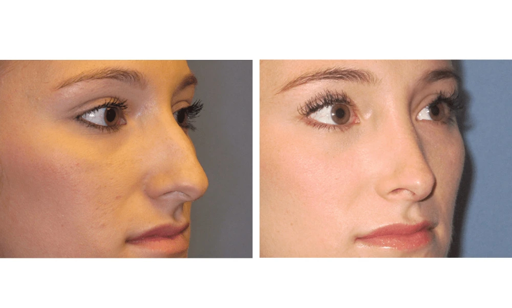 Rhinoplasty - Case 5 (6)