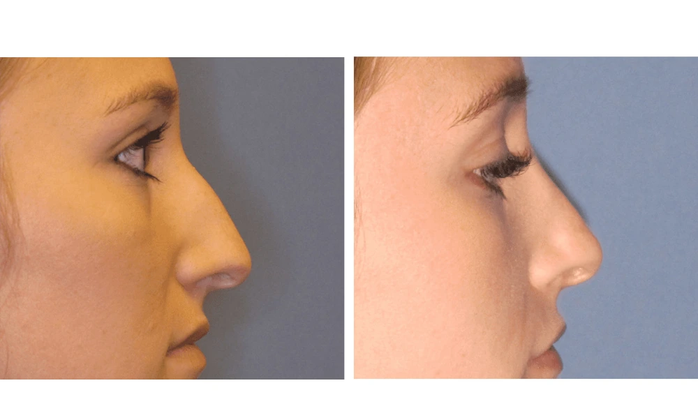 Rhinoplasty - Case 5 (7)