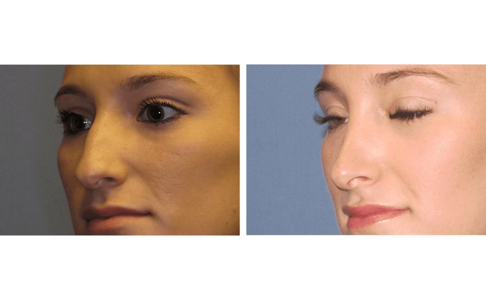 Rhinoplasty - Case 5 (8)