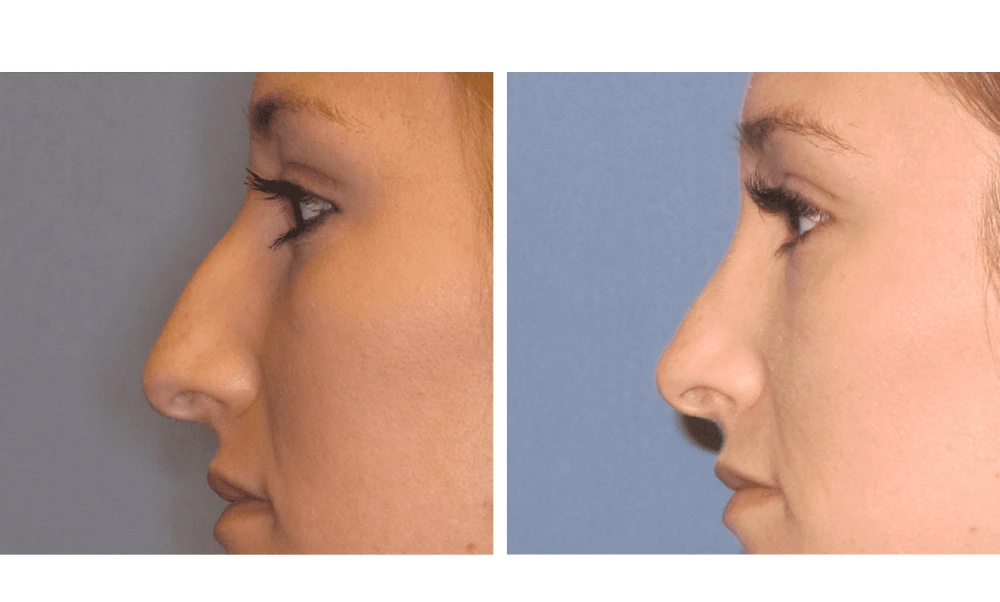 Rhinoplasty - Case 5 (9)