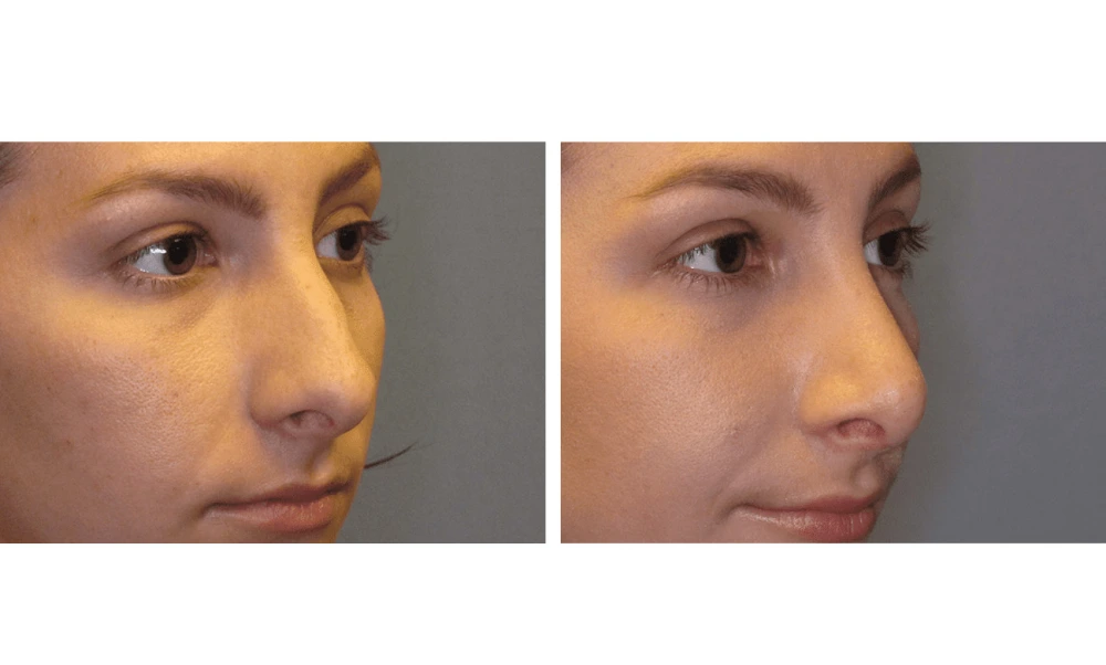 Rhinoplasty - Case 6 (1)