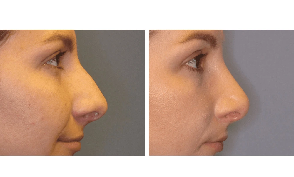 Rhinoplasty - Case 6 (2)