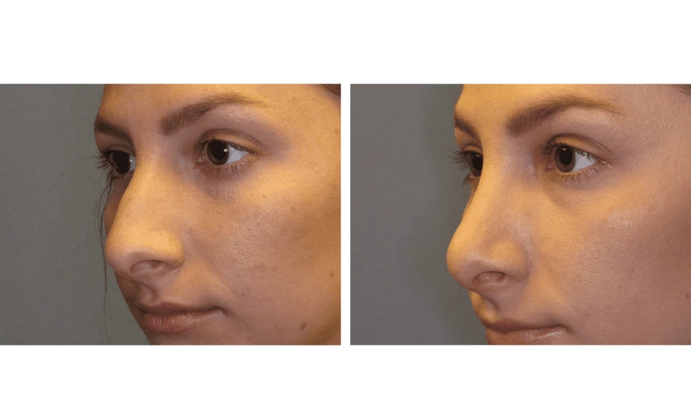 Rhinoplasty - Case 6 (3)