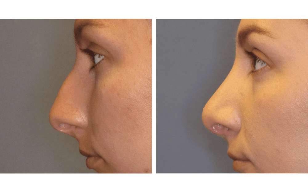 Rhinoplasty - Case 6 (4)