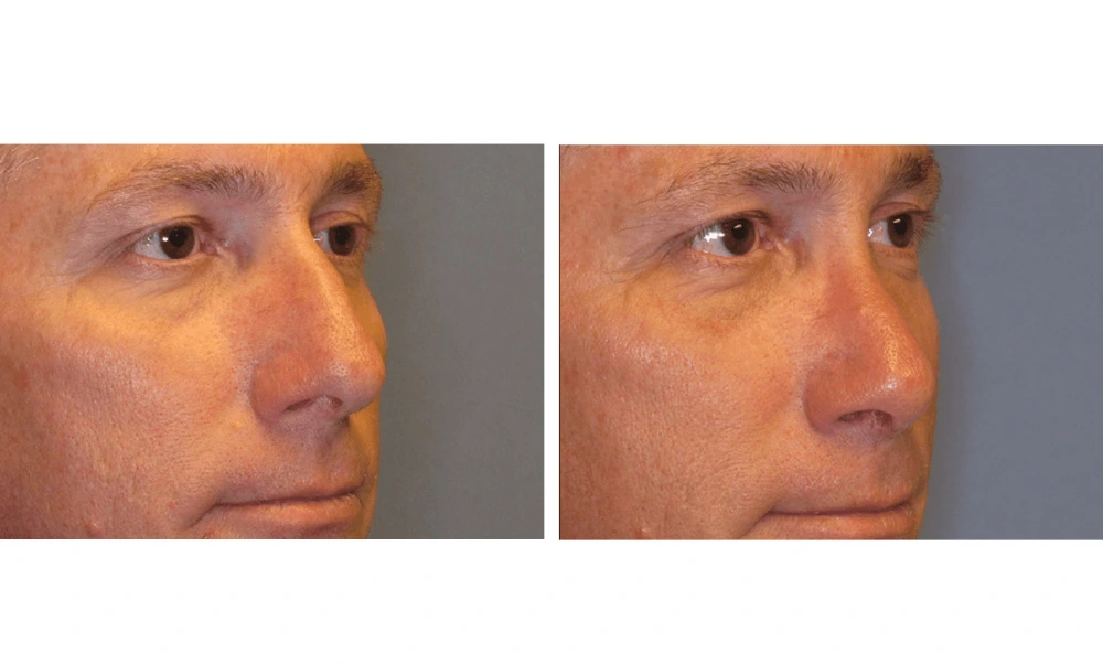 Rhinoplasty - Case 7 (1)
