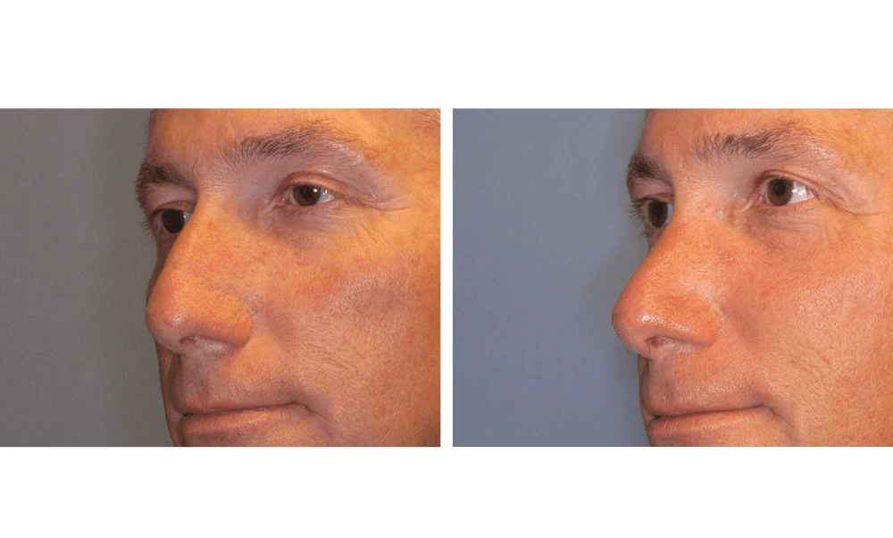Rhinoplasty - Case 7 (3)