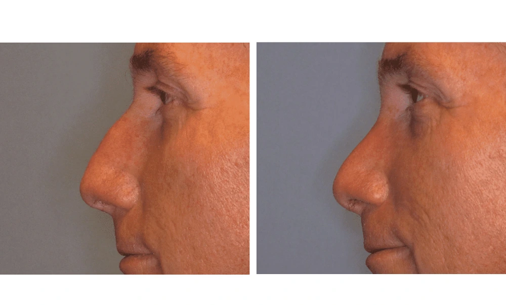 Rhinoplasty - Case 7 (4)