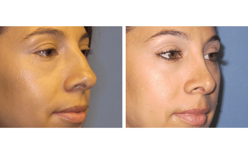 Rhinoplasty - Case 8 (1)