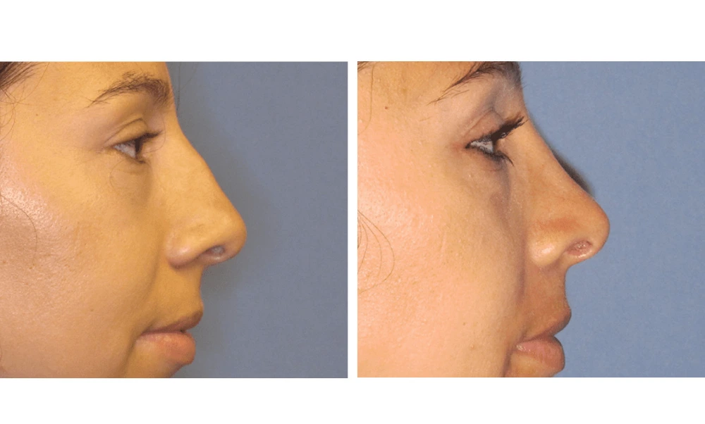 Rhinoplasty - Case 8 (2)