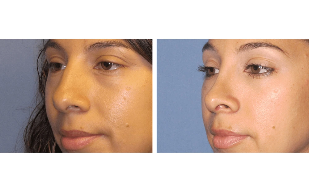 Rhinoplasty - Case 8 (3)