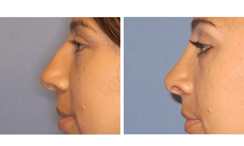 Rhinoplasty - Case 8 (4)