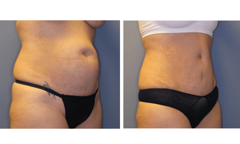 Tummy Tuck - Case 1 (1)