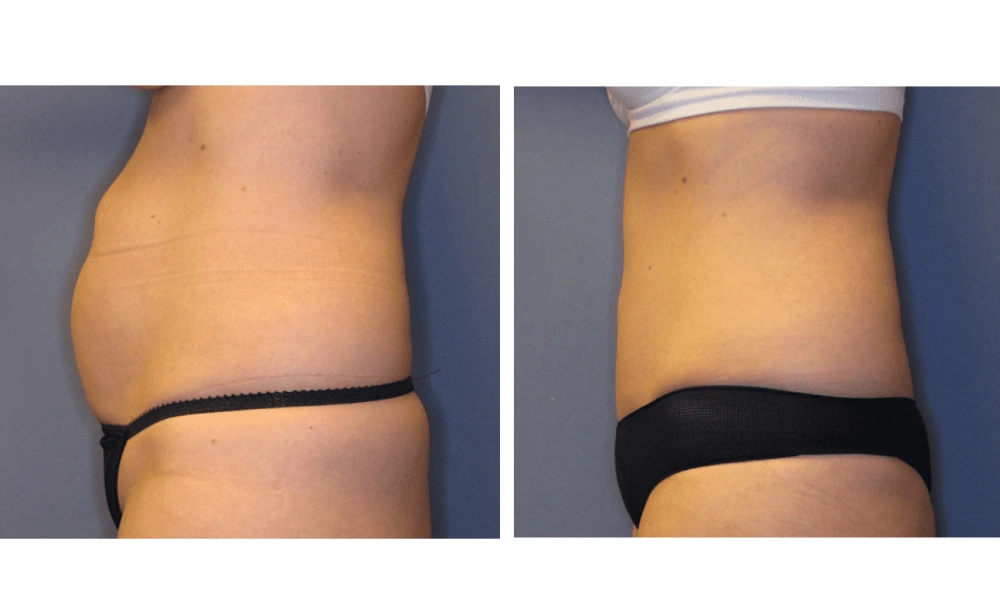 Tummy Tuck - Case 1 (4)