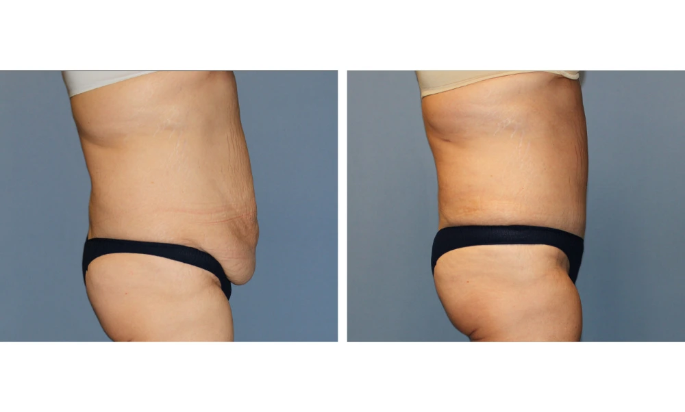 Tummy Tuck - Case 11 (1)