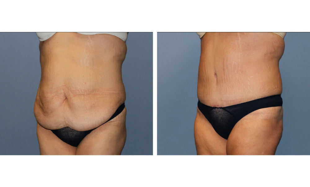 Tummy Tuck - Case 11 (2)