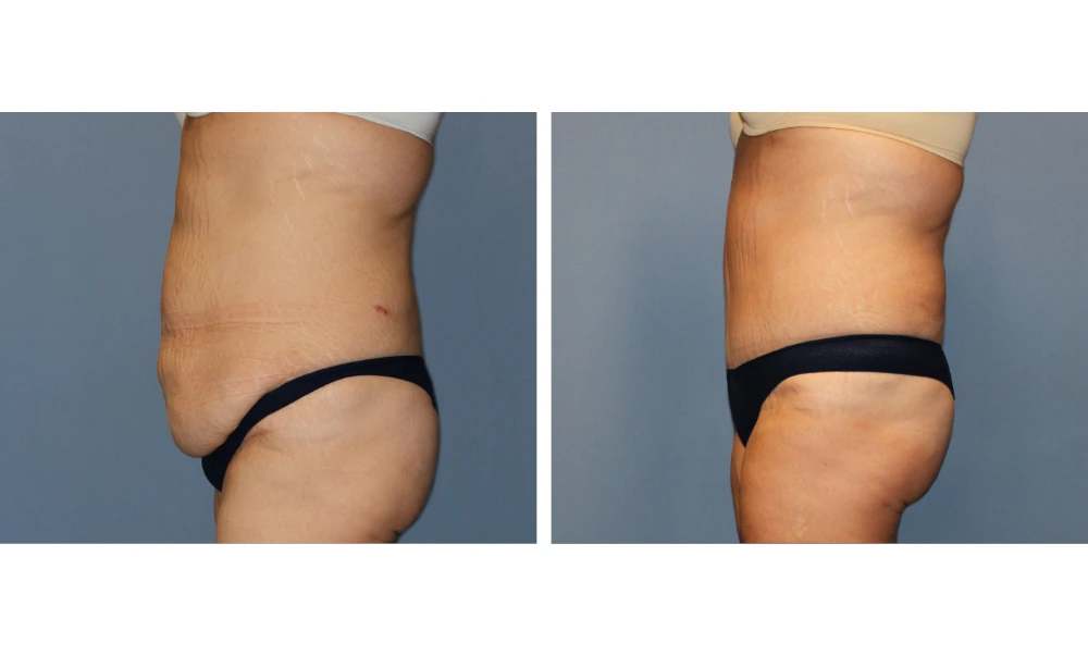 Tummy Tuck - Case 11 (3)