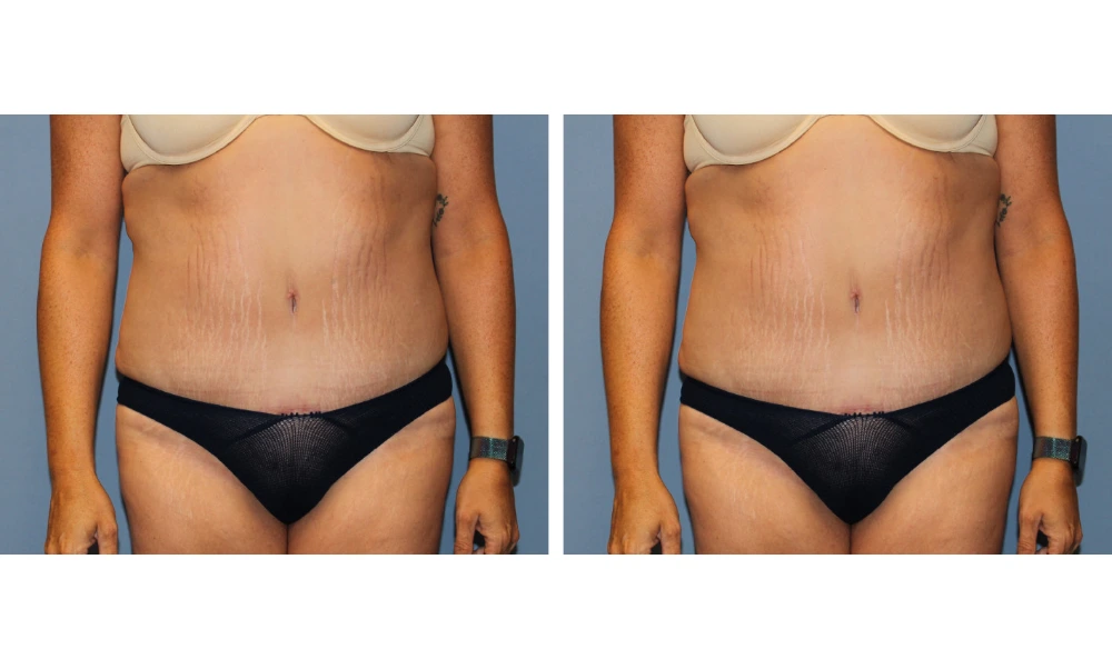 Tummy Tuck - Case 11 (4)