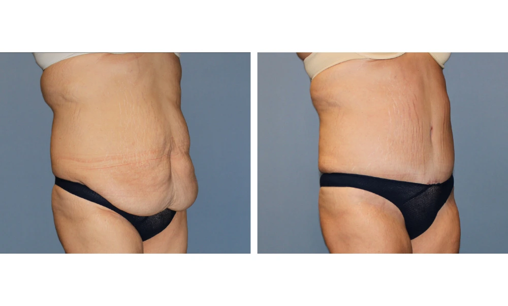 Tummy Tuck - Case 11
