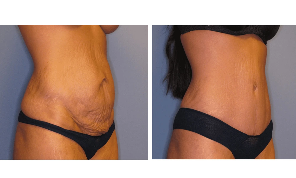 Tummy Tuck - Case 2 (1)