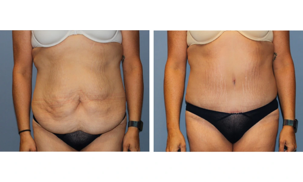 Tummy Tuck