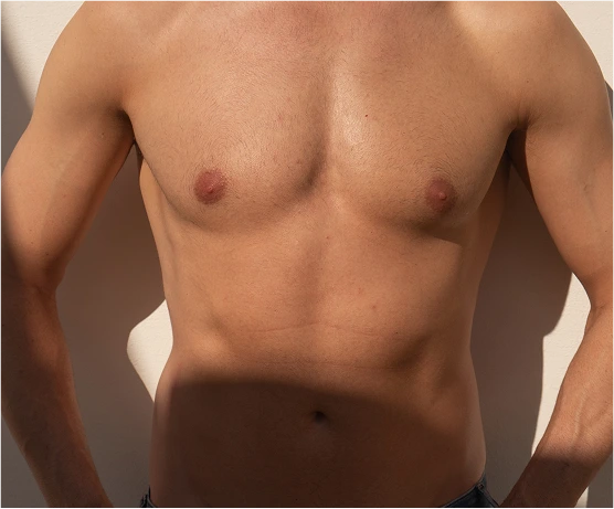 What Is Gynecomastia Scottsdale, AZ Banner